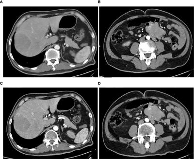 Rectosigmoid-Junction Squamous Cell Carcinoma With pMMR/MSS Achieved a Partial Response Following PD-1 Blockade Combined With Chemotherapy: A Case Report